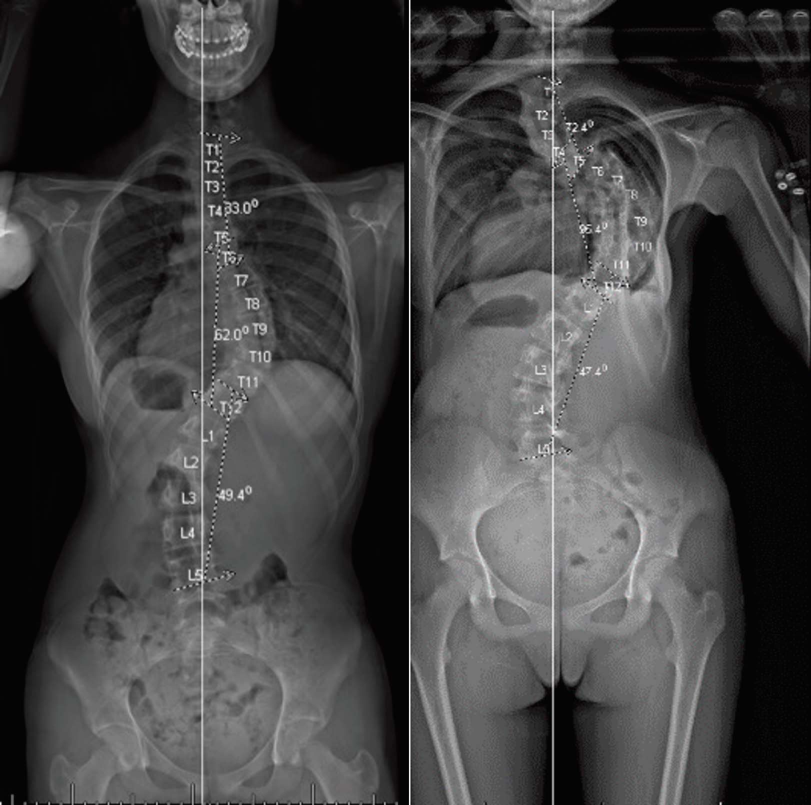 X-ray images showing scoliosis affected spines