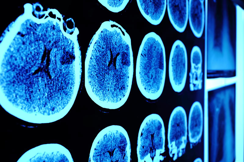 CT scans of brain