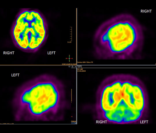 Nuclear radiology scan