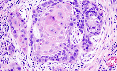 oral squamous cell carcinoma