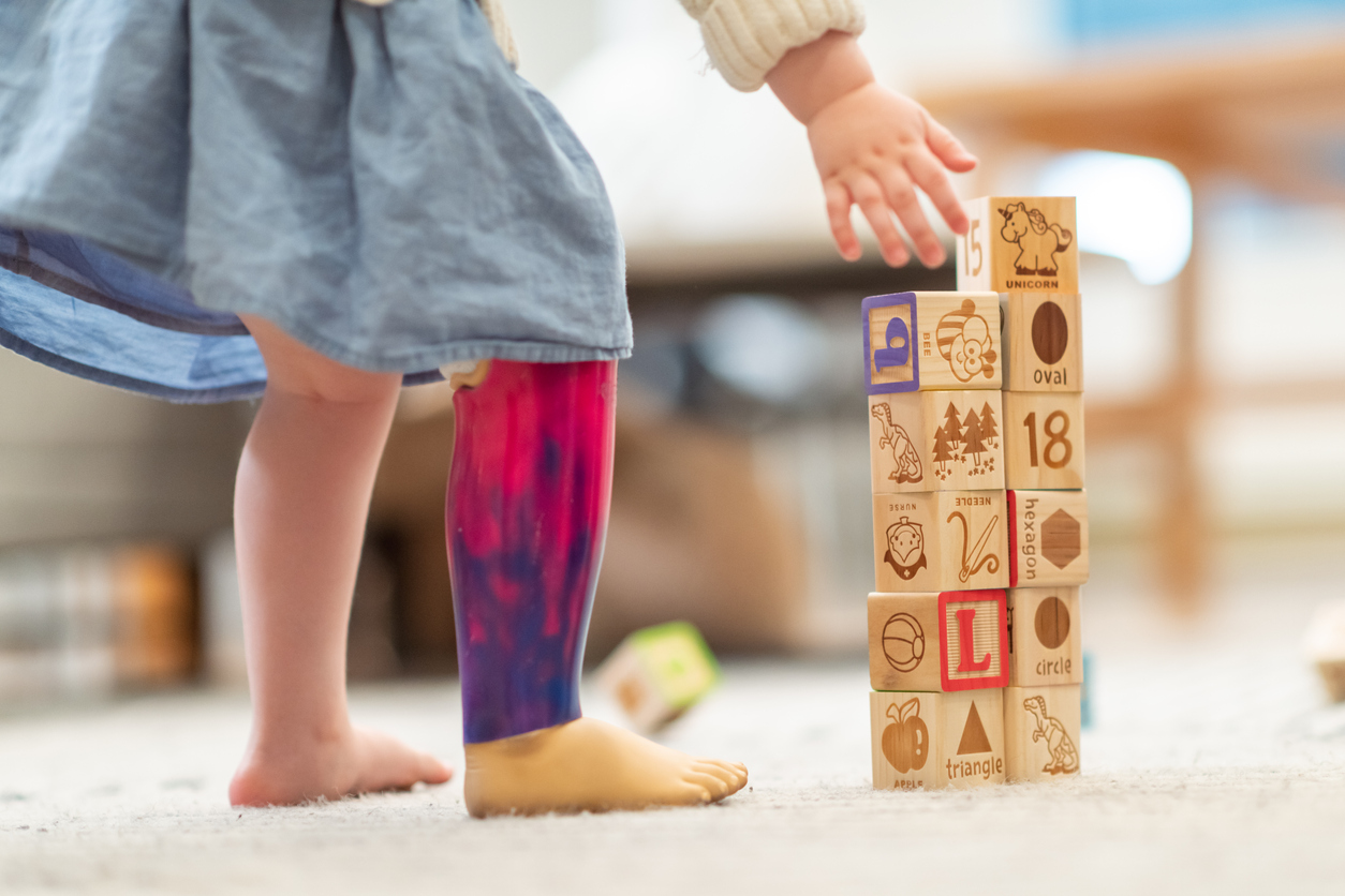preschool girl with prosthetic leg