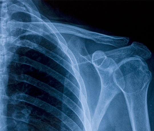 Shoulder X-Ray