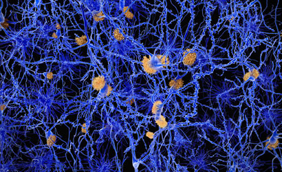 microscopic view of Alzheimer's disease