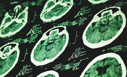 brain MRI scan