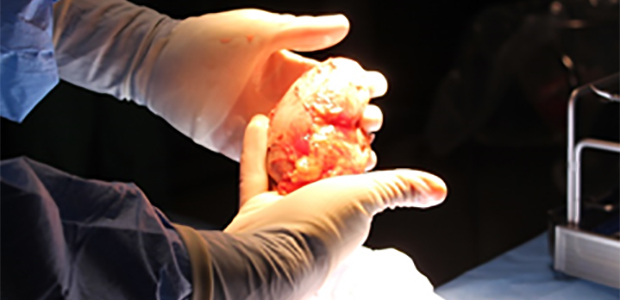 University Transplant Center surgeon holding a tissue specimen