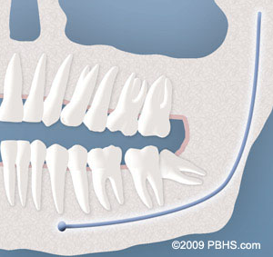 Partially impacted wisdom shop tooth
