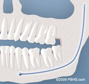 soft impaction