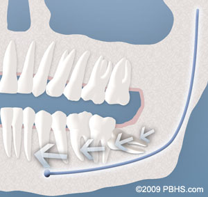 wisdom tooth cyst formation