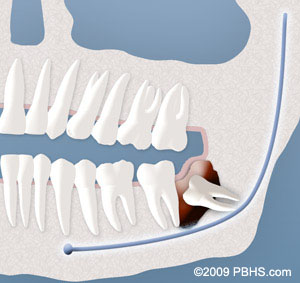 wisdom tooth cyst formation