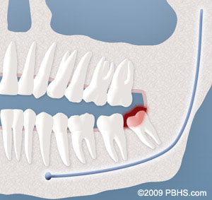 wisdom tooth infection