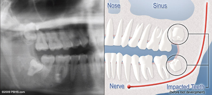 xray and drawering