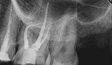 X-ray image of a patient's tooth pulp before root canal treatment