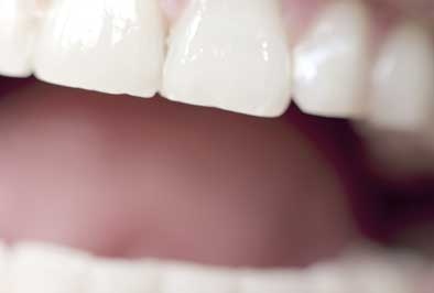 Patient's healthy smile after undergoing gum grafting 