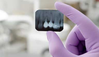 Dentist holding x-ray of patient's impacted teeth